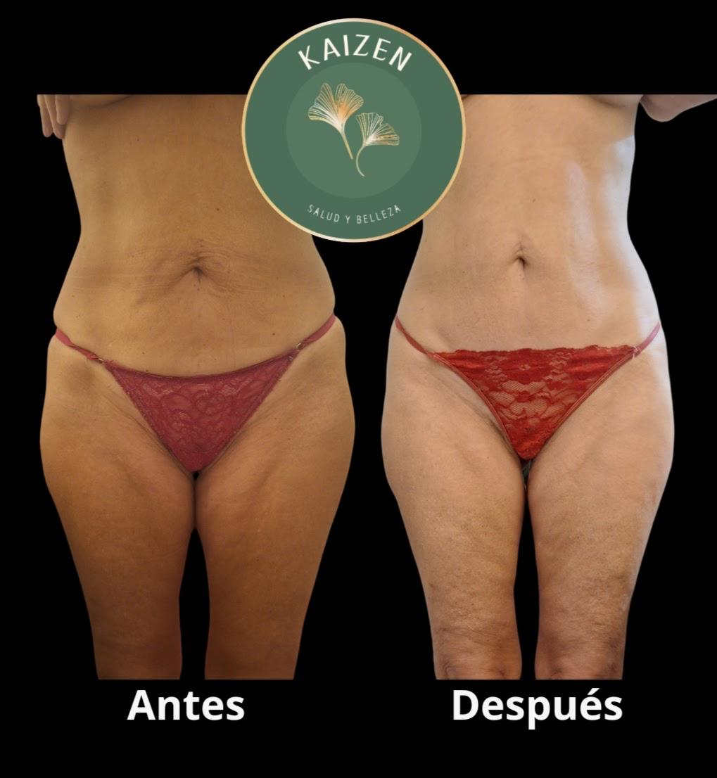 Drenaje y modelado corporal Kaizen Spa