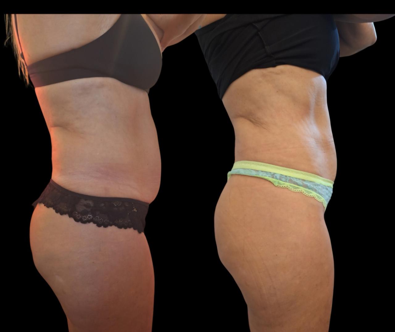 Drenaje y modelado corporal Kaizen Spa