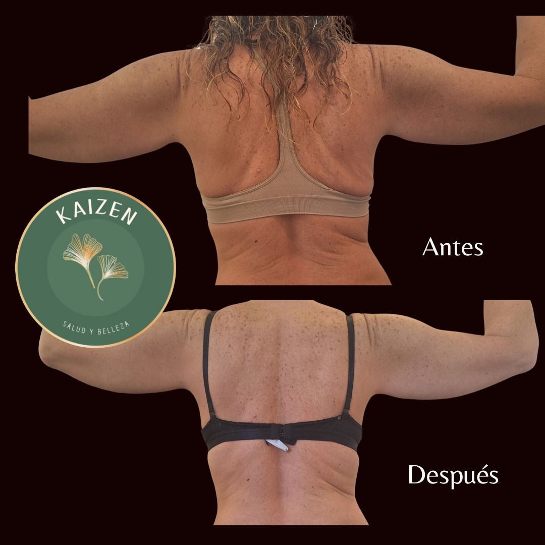 Maderoterapia Kaizen Spa